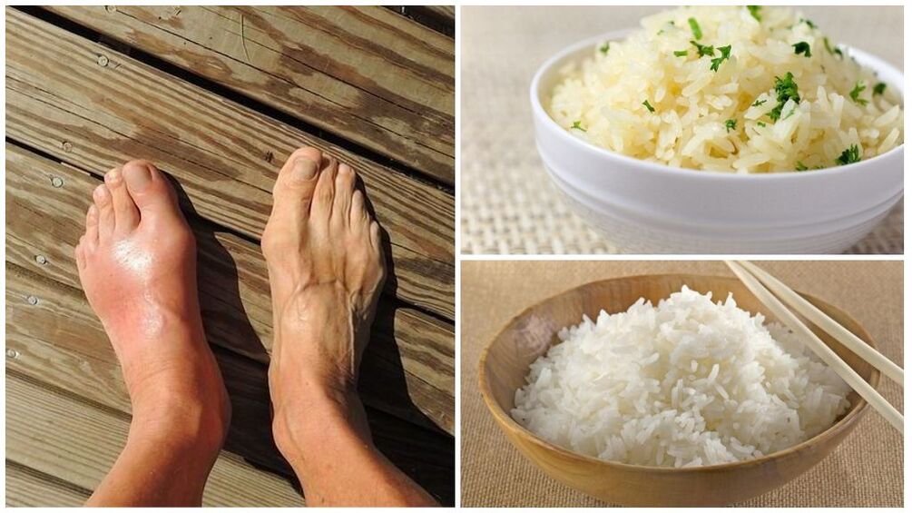 A rice -based diet is recommended for gout patients. 